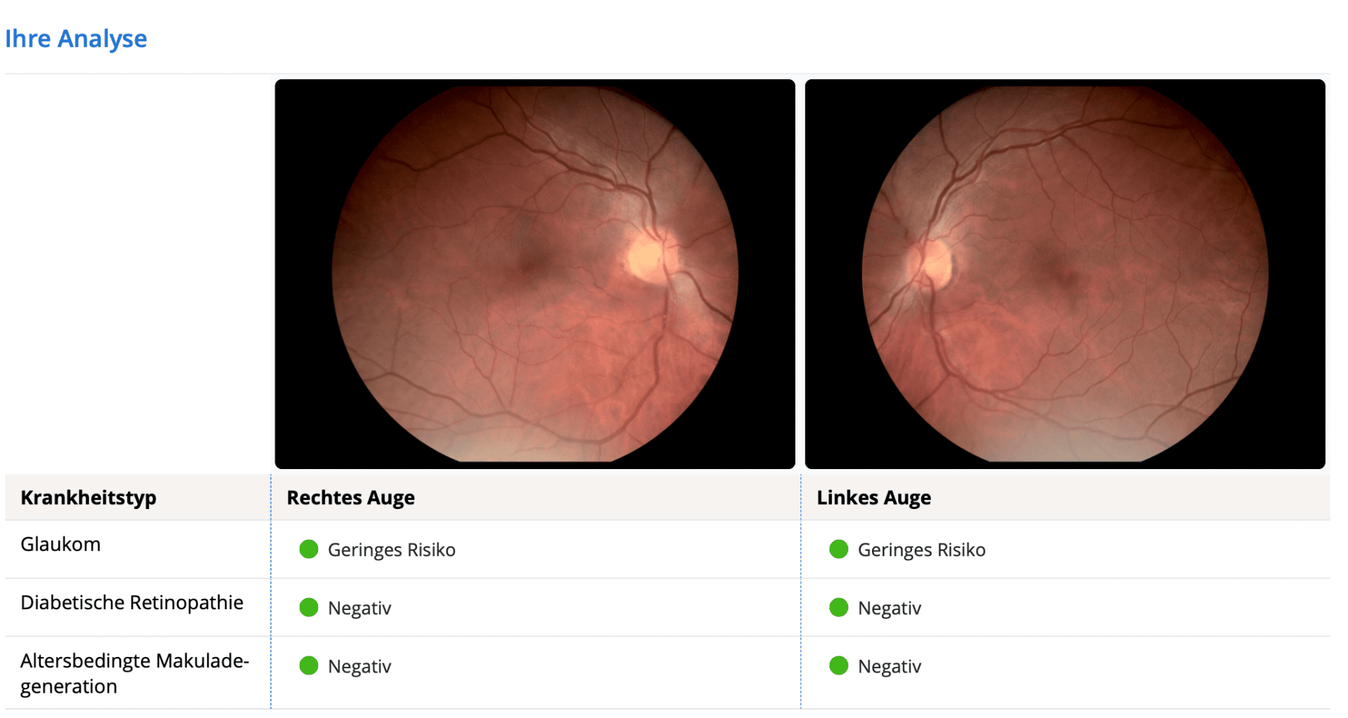 Über einer Tabelle sind zwei Bilder des Netzhauthintergrunds dargestellt, die als rechtes und linkes Auge gekennzeichnet sind. Die Tabelle weist auf ein geringes Glaukomrisiko und keine Anzeichen einer diabetischen Retinopathie oder Makuladegeneration in beiden Augen hin.