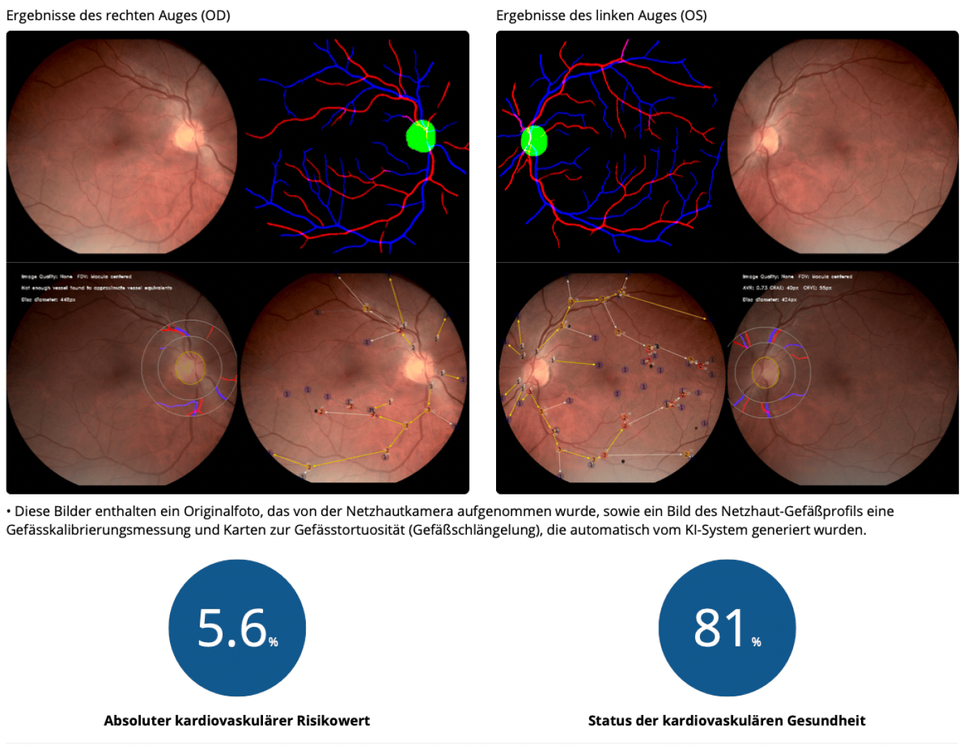 Zwei Netzhautbilder mit farbigen Markierungen zeigen die Ergebnisse für rechtes und linkes Auge. Unten stehen: 5,6 % kardiovaskuläres Risiko und 81 % kardiovaskuläre Gesundheit mit entsprechenden Symbolen.