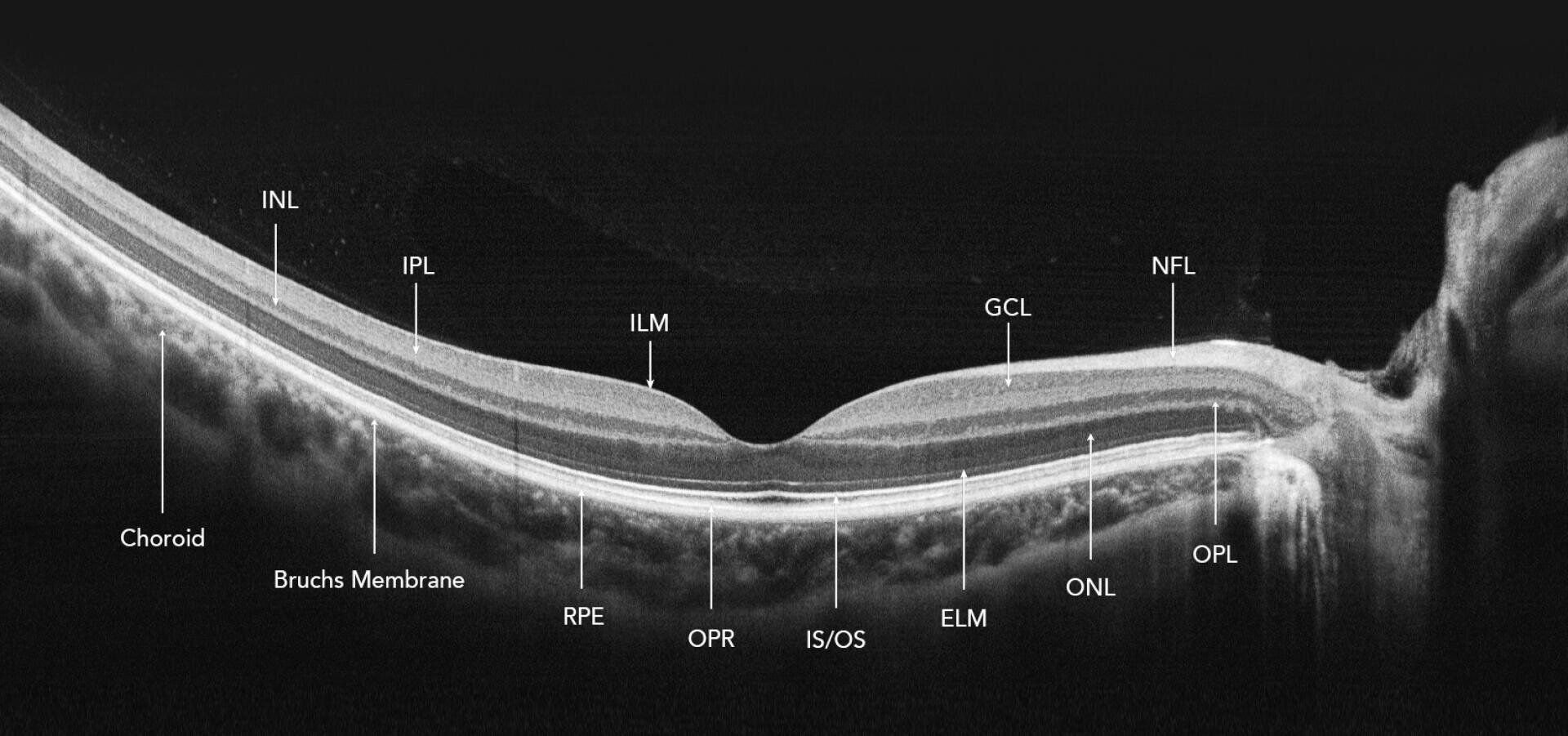 Querschnittsbild der optischen Kohärenztomographie (OCT) der Netzhaut, beschriftet zur Darstellung verschiedener Netzhautschichten, einschließlich Aderhaut, Bruch-Membran, RPE, OPL, INL, IPL, ILM, GCL, NFL, ONL, ELM, IS/OS und OPR.