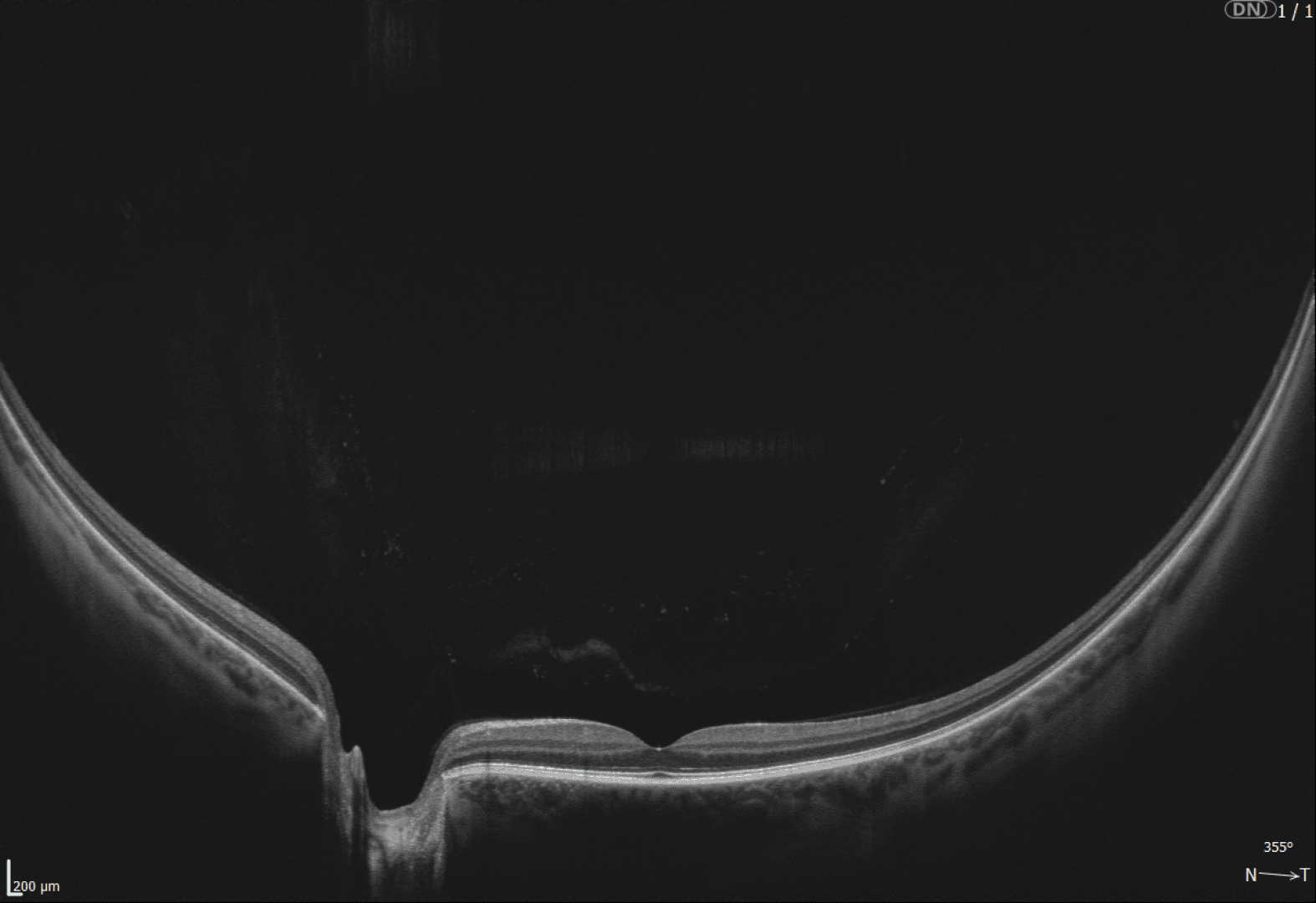 Schwarz-Weiß-Aufnahme eines Auges mit optischer Kohärenztomographie (OCT). Sie zeigt die Querschnittsschichten der Netzhaut und eine konkave Vertiefung, die den Sehnervenkopf oder die Makula darstellt. Der Maßstab ist unten links sichtbar.