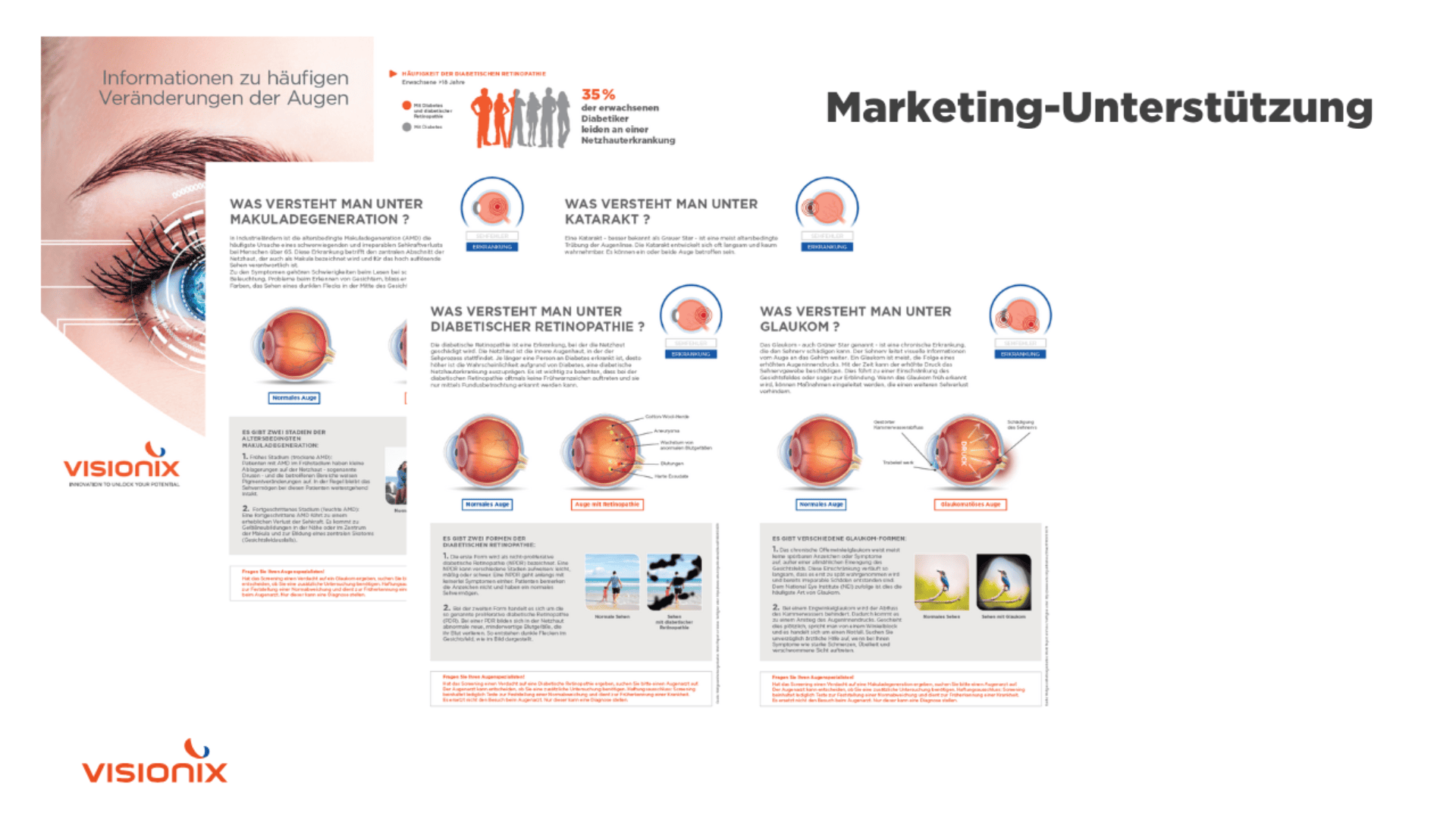 Eine Reihe deutschsprachiger Marketingmaterialien von Visionix zu häufigen Augenerkrankungen mit Augendiagrammen, Informationstexten und Grafiken zur Veranschaulichung von Krankheiten wie Makuladegeneration, Katarakt, diabetischer Retinopathie und Glaukom.