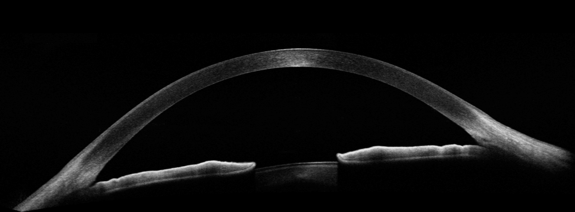 Medizinischer Querschnittsscan eines Auges, der oben eine klare, gekrümmte Hornhaut und darunter die unregelmäßigen Oberflächen der Iris und Linse zeigt, alles in kontrastreichem Schwarzweiß.