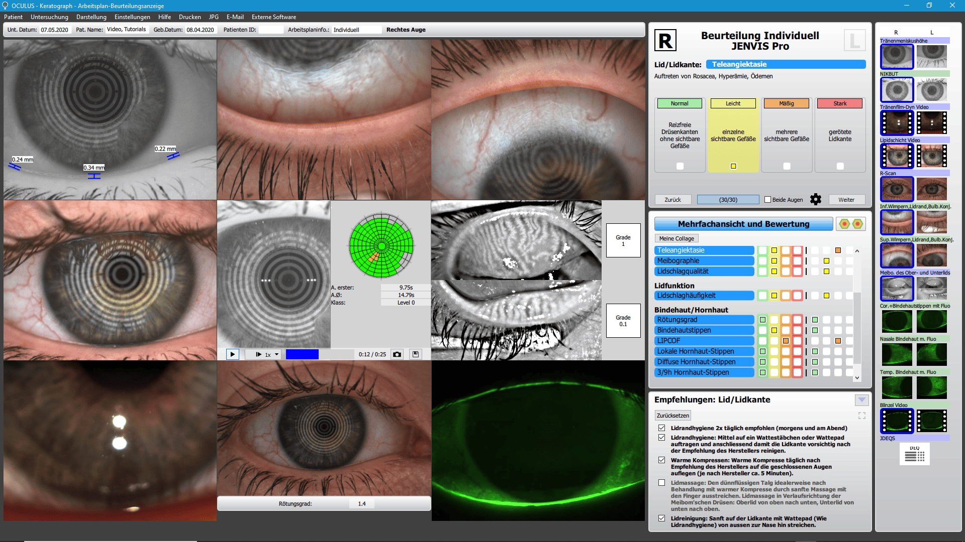 Auf einer Softwareoberfläche werden detaillierte Bilder der Augenuntersuchung, Diagnosedaten, Hornhautscans und eine Bewertungstabelle für die ophthalmologische Analyse und Linsenanpassung mit mehreren Nahaufnahmen des Auges und Diagnoseergebnissen angezeigt.