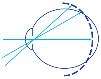 Schema eines Augapfels mit drei Lichtstrahlen, die in das Auge eintreten. Die Strahlen laufen hinter der Netzhaut zusammen, was einen Zustand wie Hyperopie (Weitsichtigkeit) verdeutlicht.