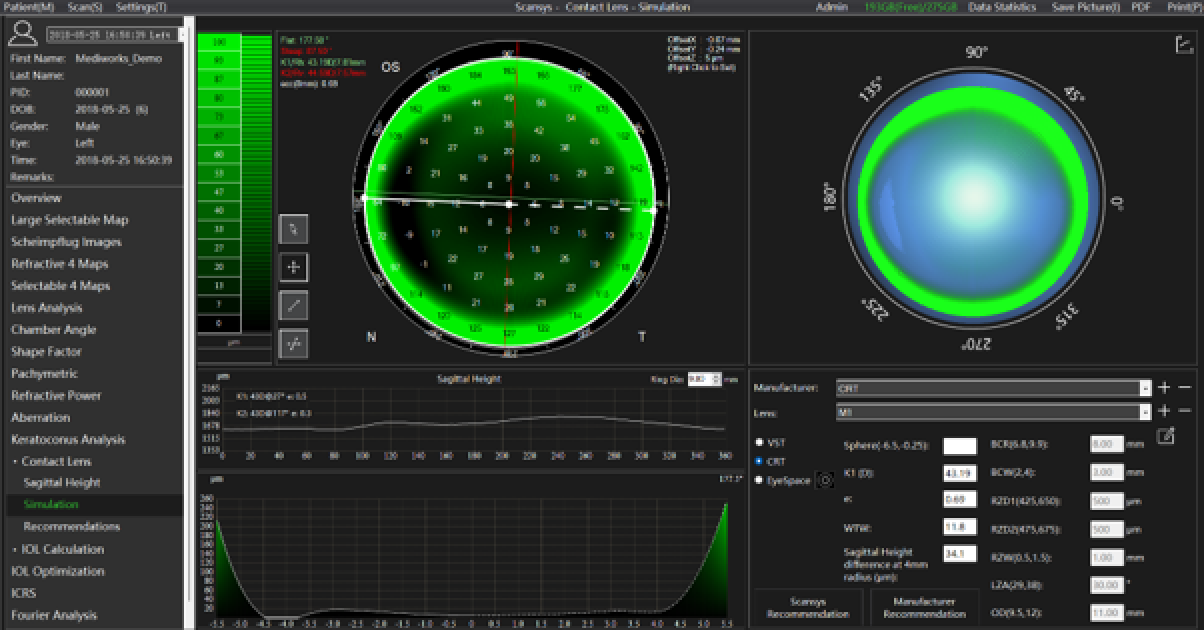 Bildschirmfoto einer ophthalmologischen Diagnosesoftware, die Hornhauttopographiedaten anzeigt, einschließlich einer Farbkarte, Kreisdiagrammen, einem sagittalen Höhendiagramm, Messwerten und Linsenempfehlungen.